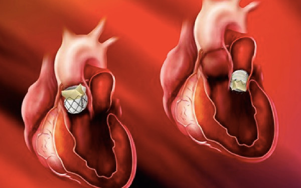 Centro Cardiovascular Universitario innova en procedimientos quirúrgicos valvulares